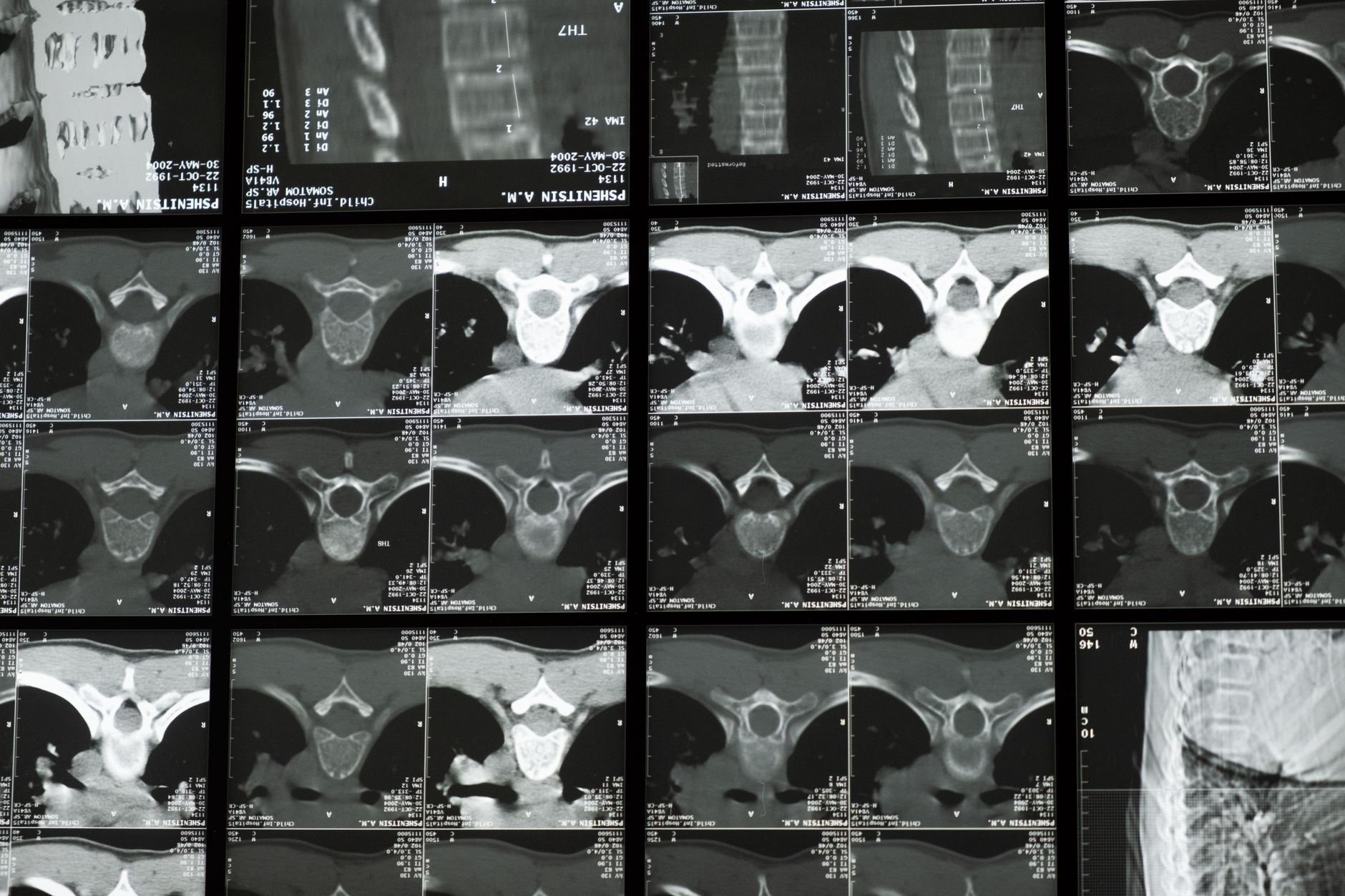 a neurosurgeon reviewing a cervical-spine MRI showing a spinal cord injury