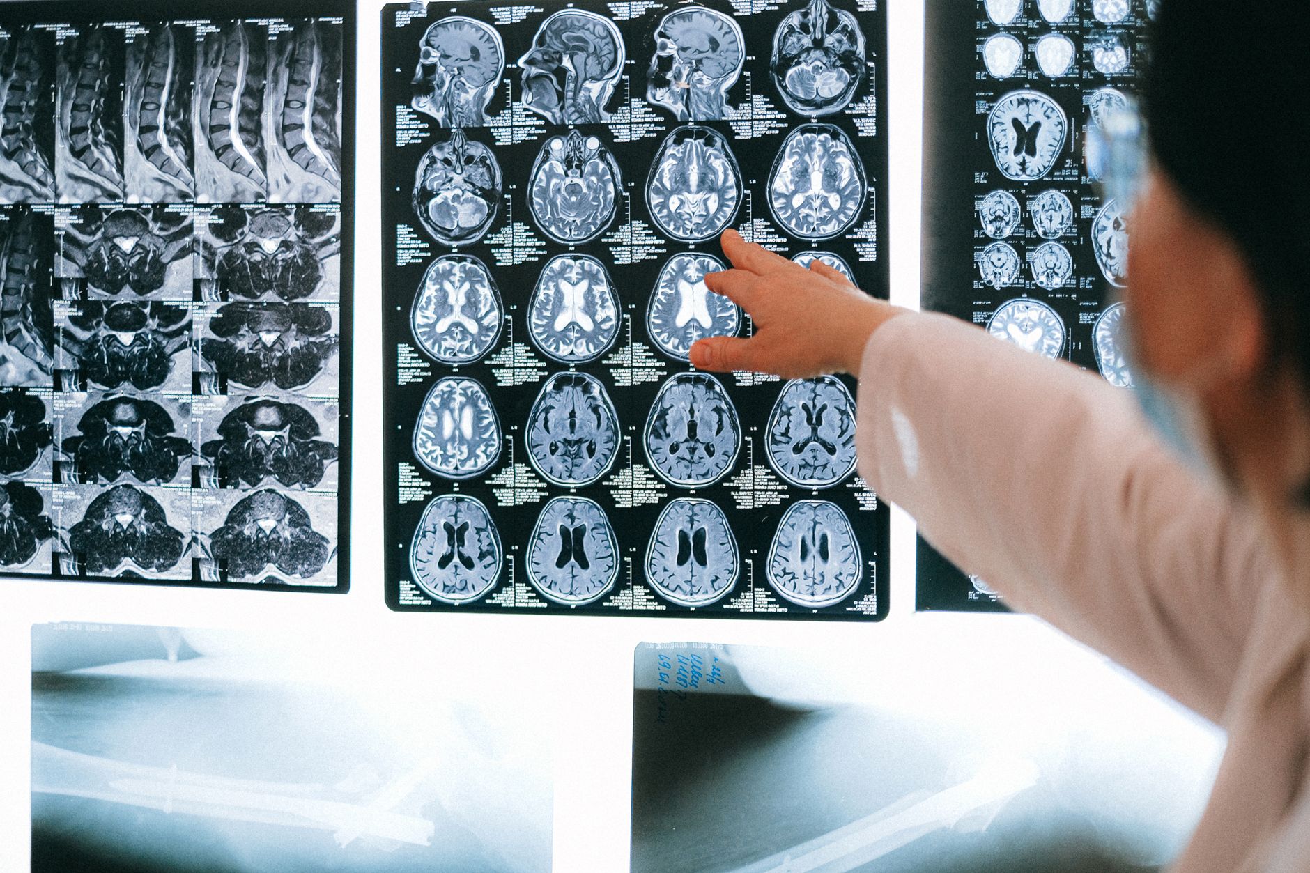 Radiologist pointing at brain MRI scans displayed on a screen during a medical examination.