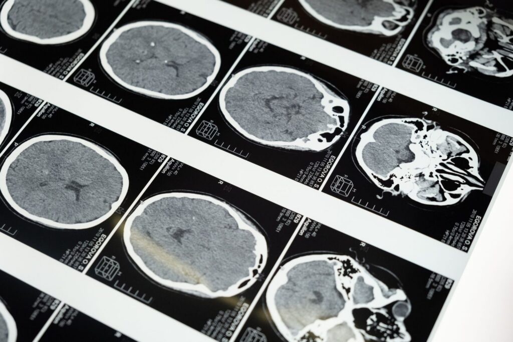 Brain MRI scans on a medical lightbox displaying detailed neurological imaging.