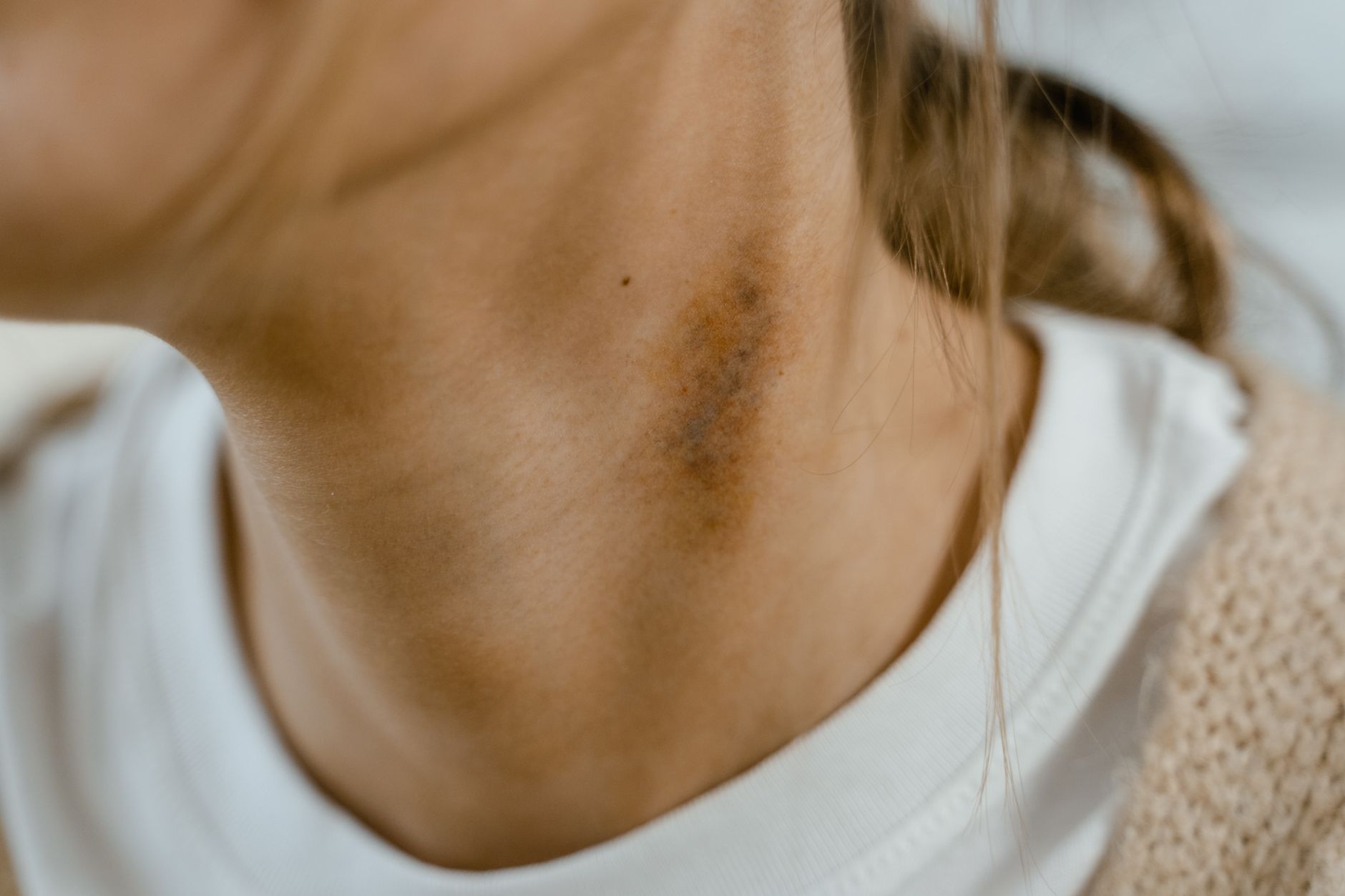 Close-up of a neck showing a visible bruise and scar on textured skin.