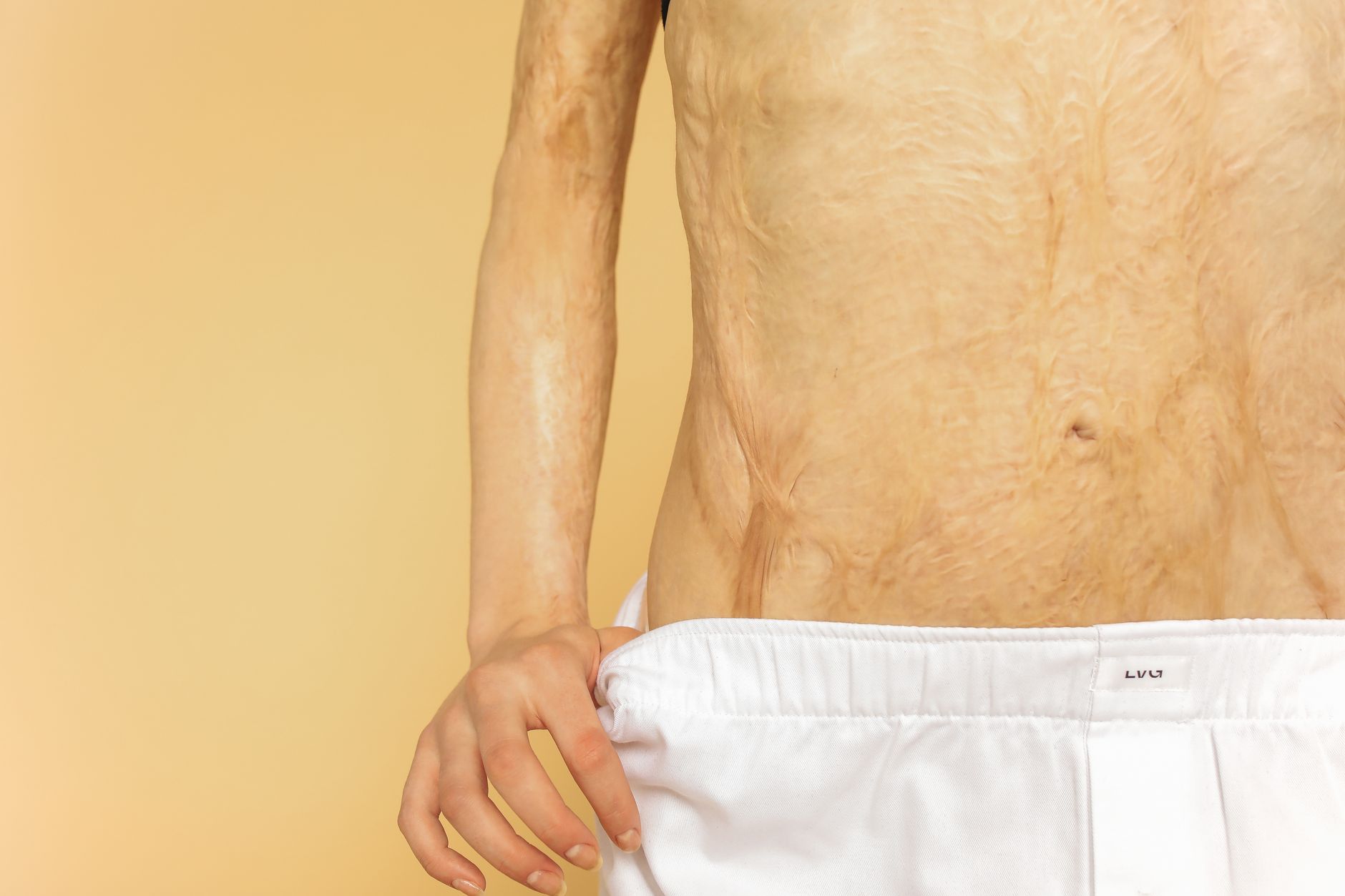 Close-up of burn scars across a person's torso against a neutral background.