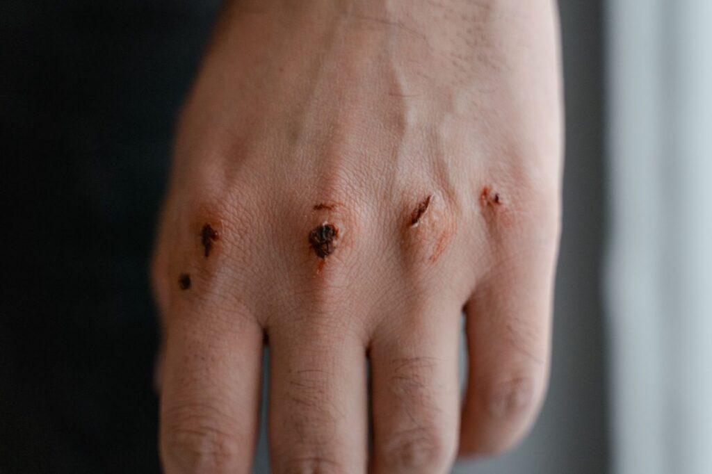 Mano con cicatrices y lesiones visibles en los nudillos.