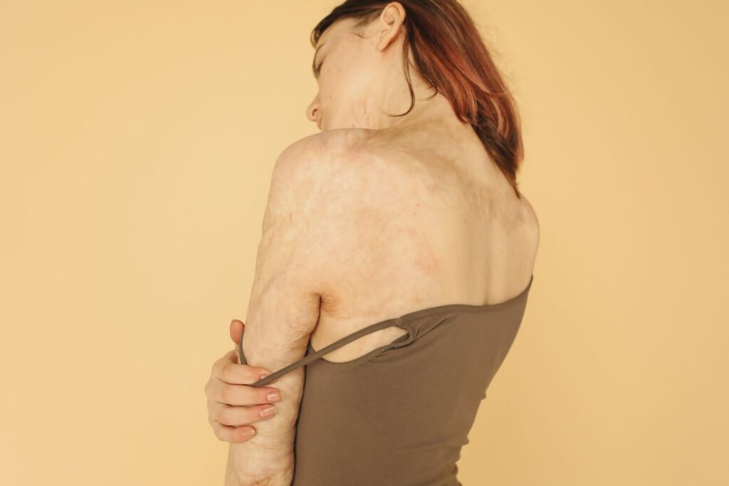 Mujer con cicatrices de quemaduras en top marrón sobre fondo beige.