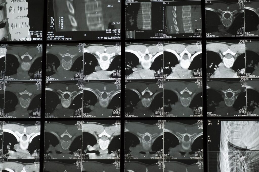 Radiografías de columna cervical y lumbar mostrando estructuras vertebrales para comparación médica.