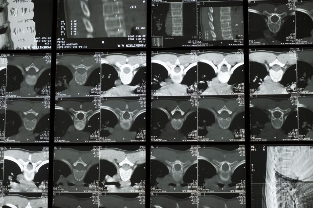 Radiological scan of the human spine showing vertebrae and disc structure for medical examination.
