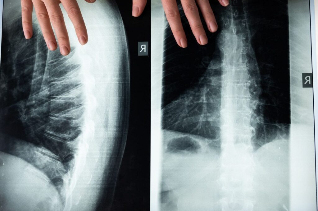 Spine X-ray with hands pointing to vertebrae during medical examination.