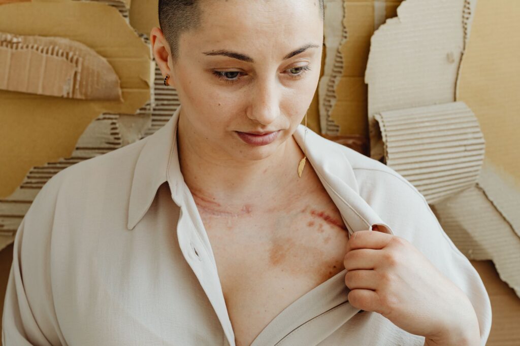 Woman displaying a healing scar on her chest, illustrating recovery after skin graft surgery.