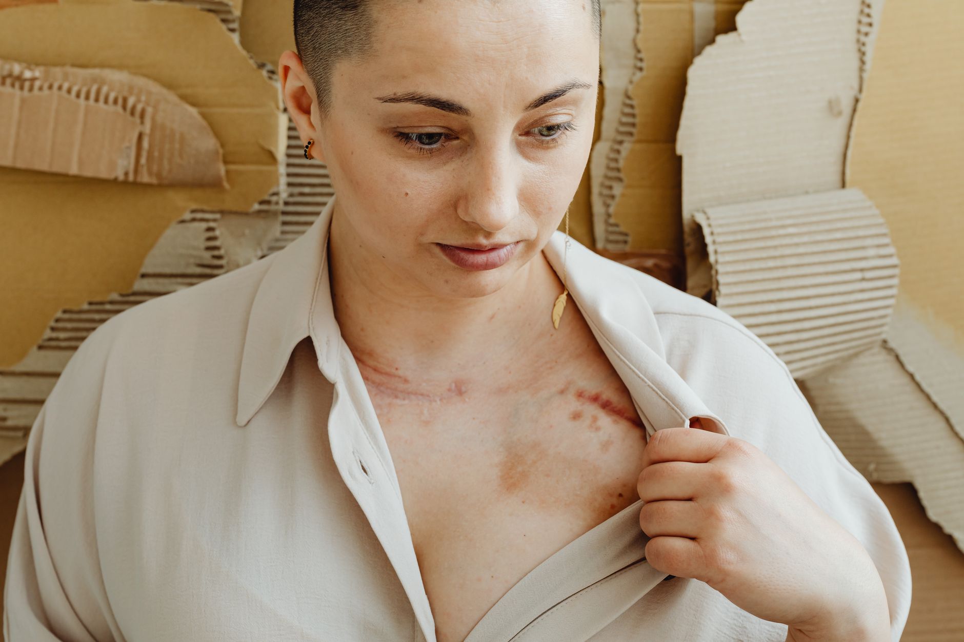 Woman displaying a healing surgical scar on her chest after skin graft recovery.