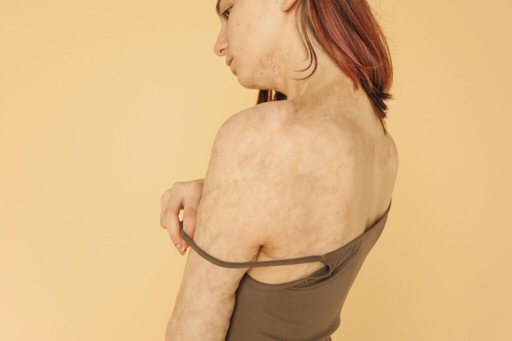 Woman displaying burn scars on her face and neck against a neutral background.