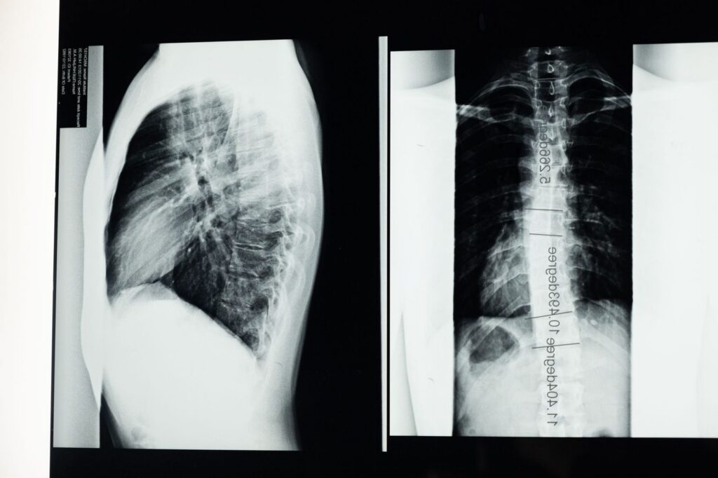 X-ray of human spine showing scoliosis curvature.