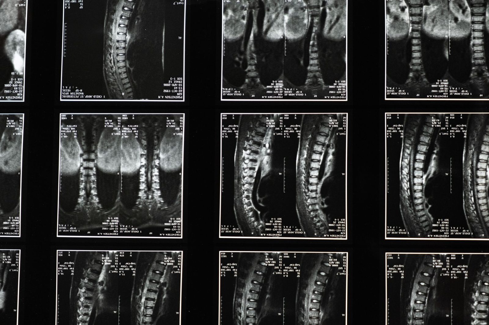 Radiografías de columna vertebral para diagnóstico médico de lesiones cervicales.