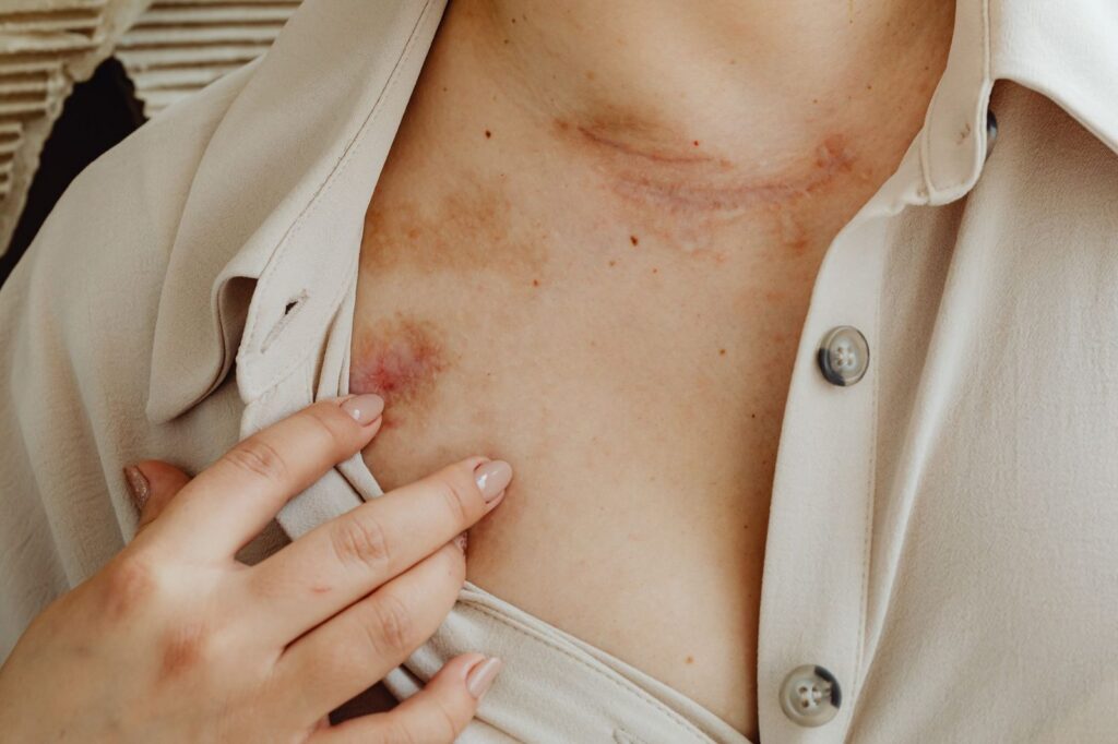 Scarred chest skin with hand touching, representing burn injury recovery.