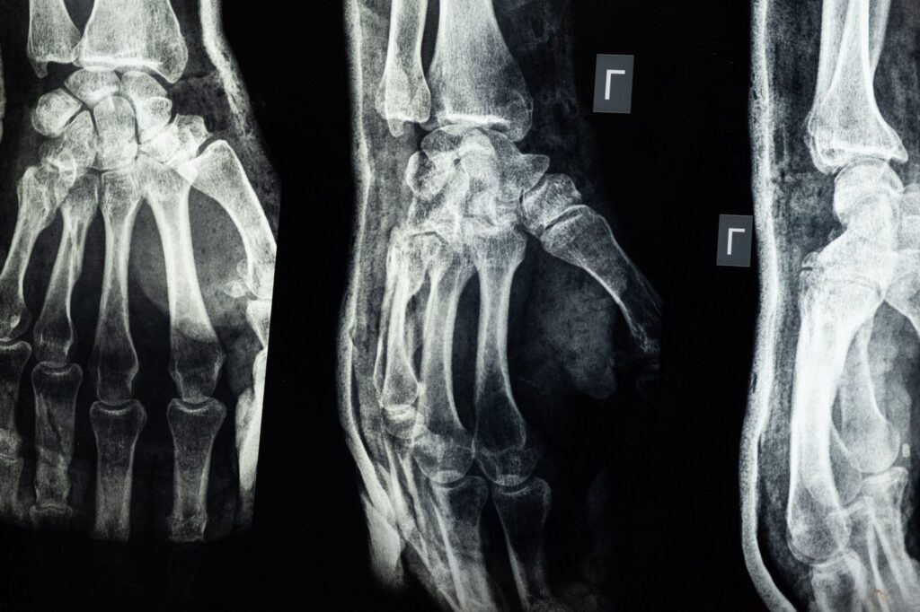X-ray of human hand bones showing skeletal structure.