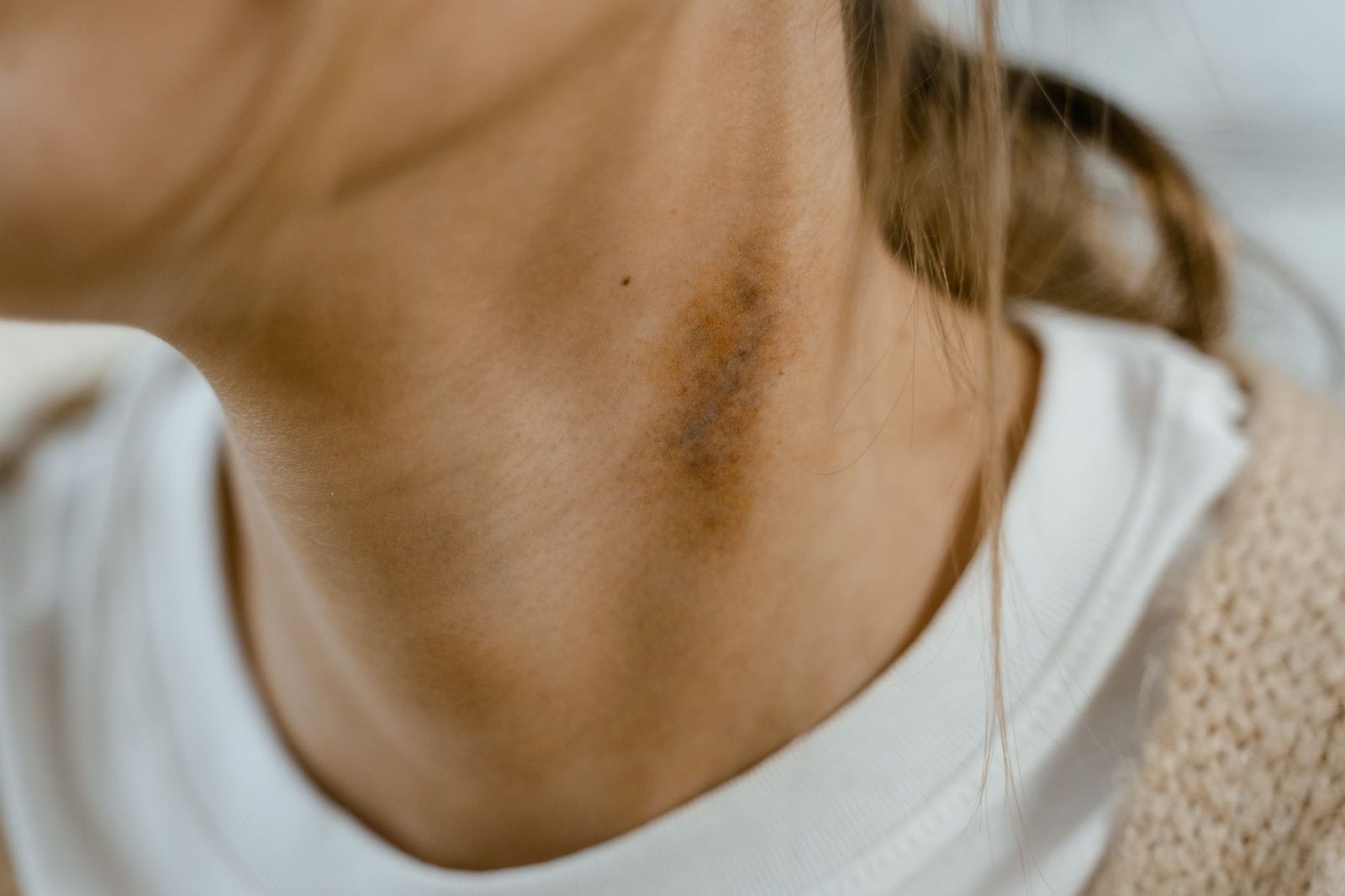 Cuello con moretón visible y textura de piel inflamada.