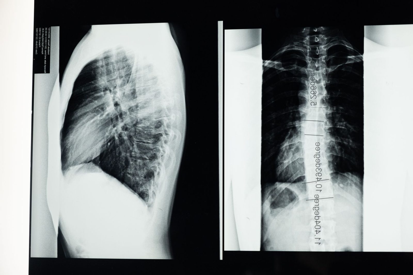 Radiografía de columna vertebral con escoliosis.